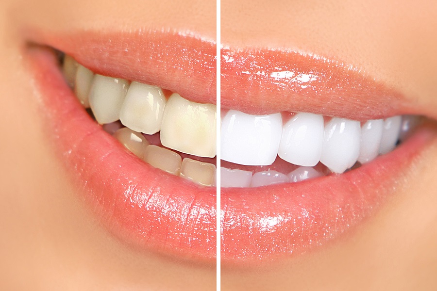 teet-whitening