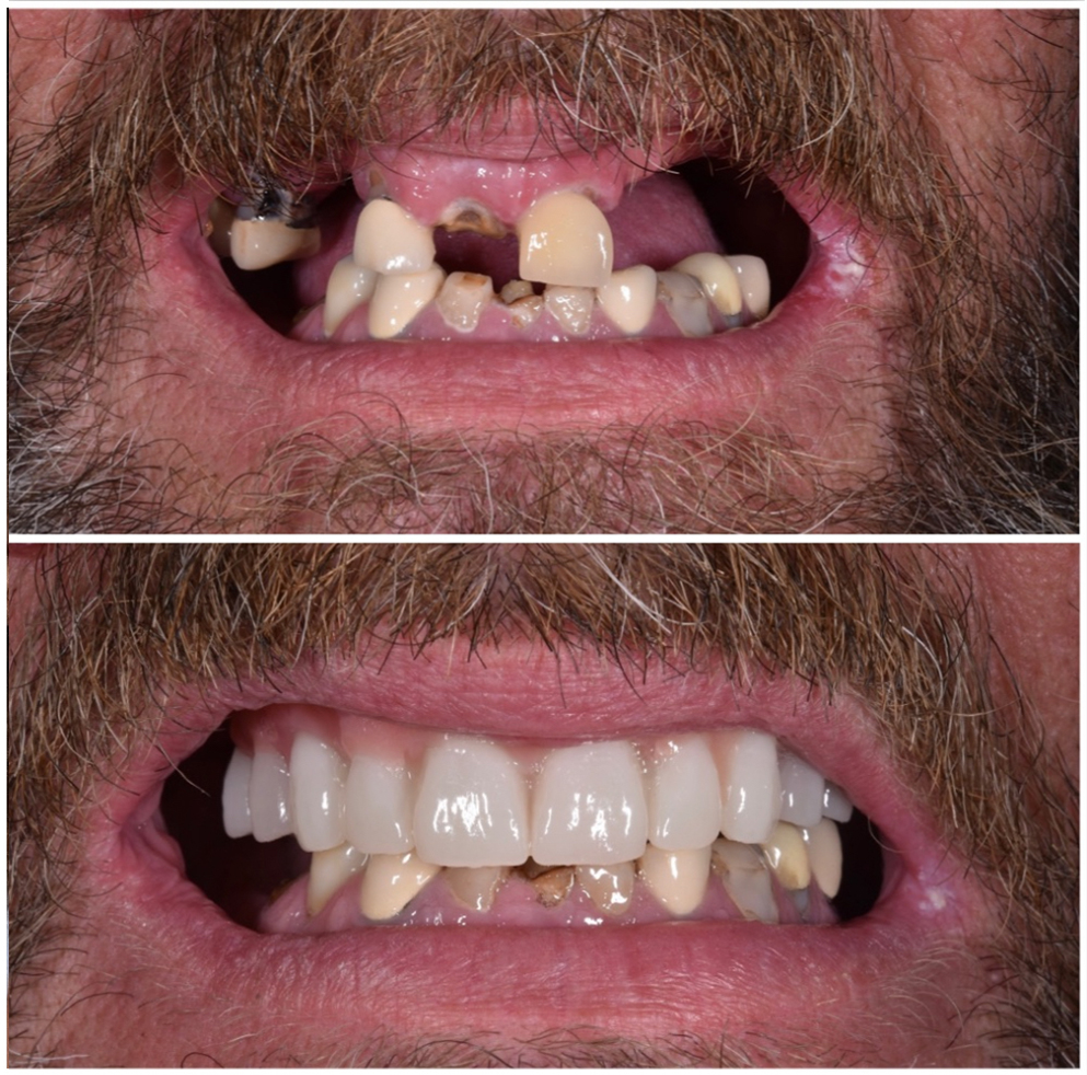 All-on-4 Implants Patient Photo