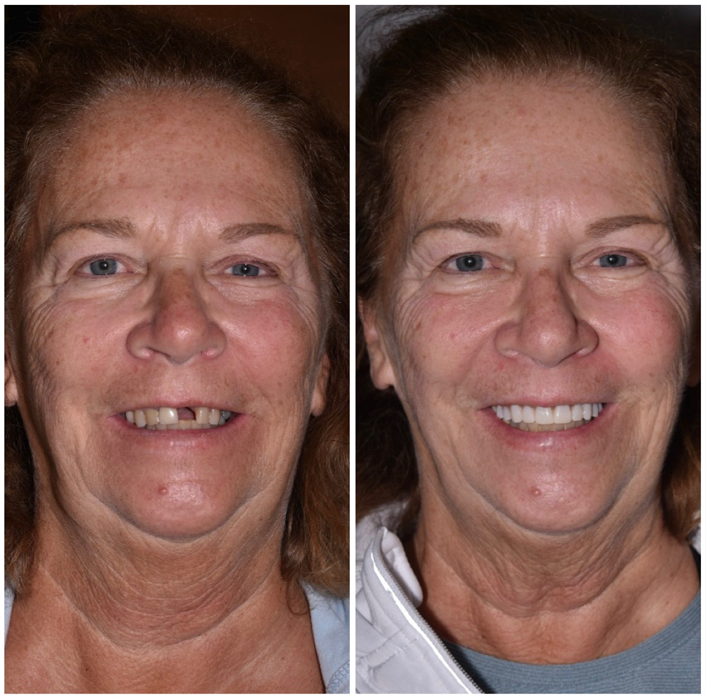 All-on-4 Implants Service