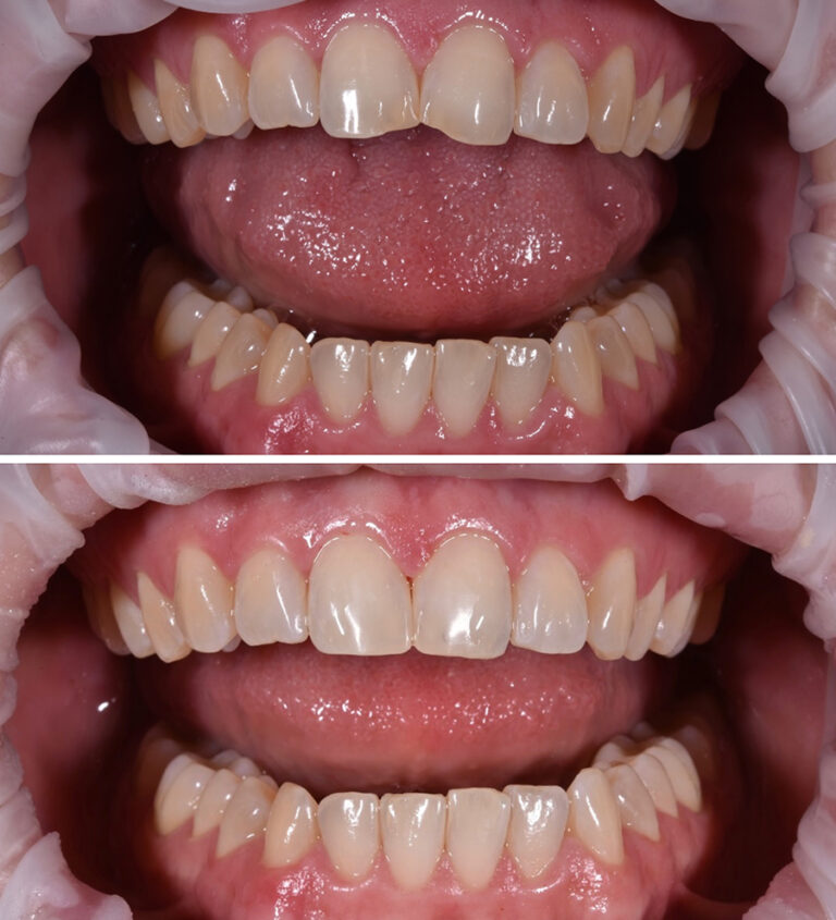 Bonding Before/After