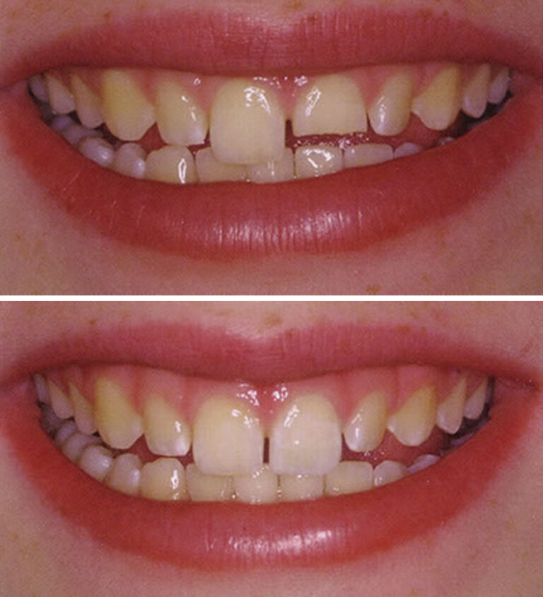 Bonding Before/After