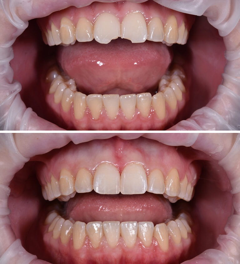 Bonding Before/After