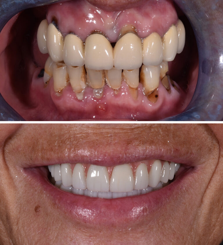 Dental Implants Before/After