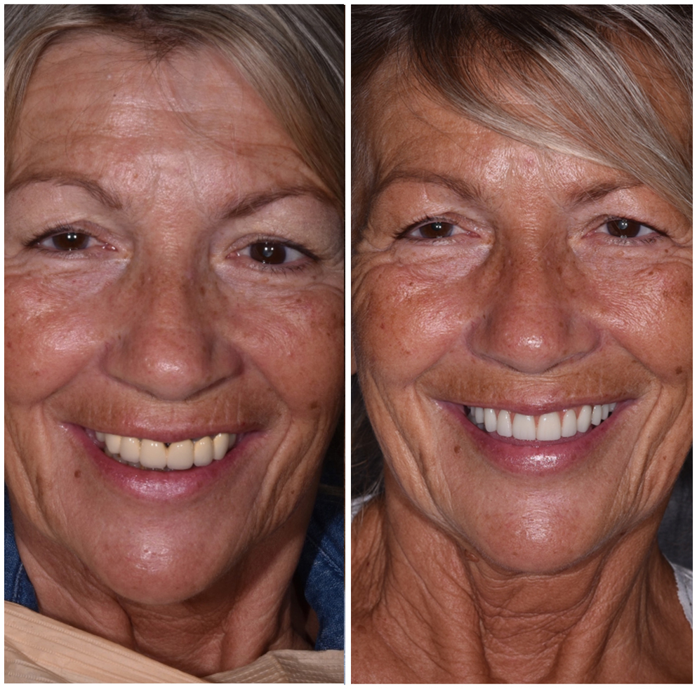 Dental Implants
