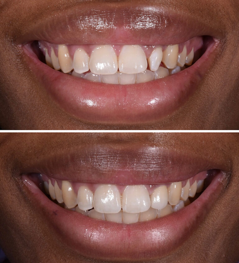 Peg Lateral Corrected With Single Veneer Before/After