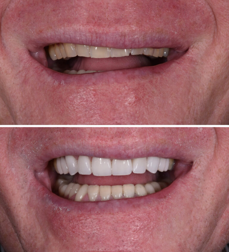 Porcelain Veneers Before/After