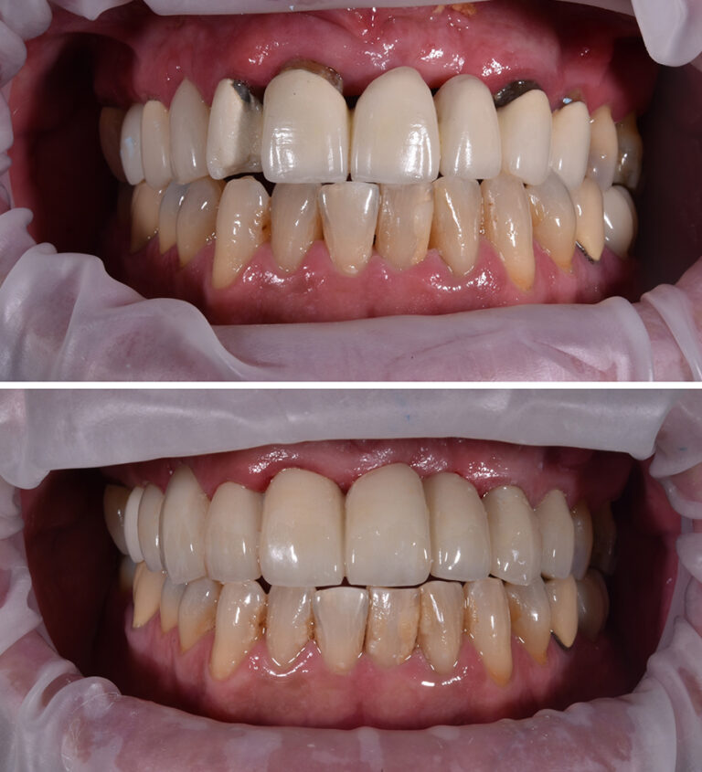 Replacing Old Crowns-Bridge Before/After