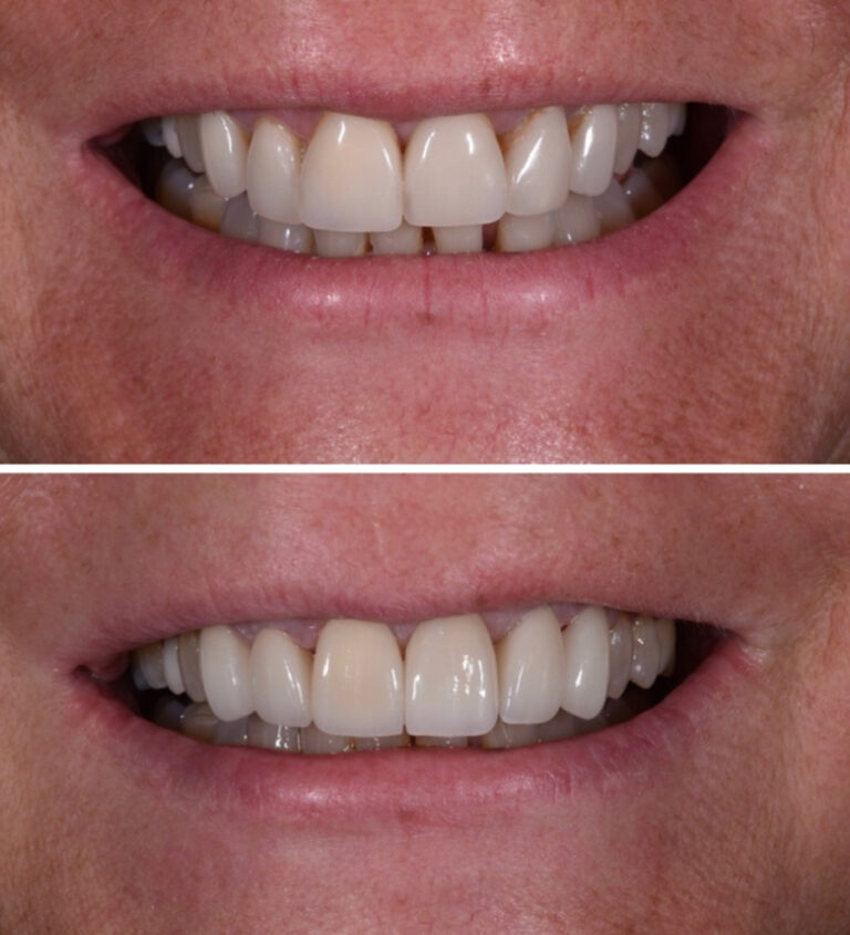 Replacing Old Veneers Before/After