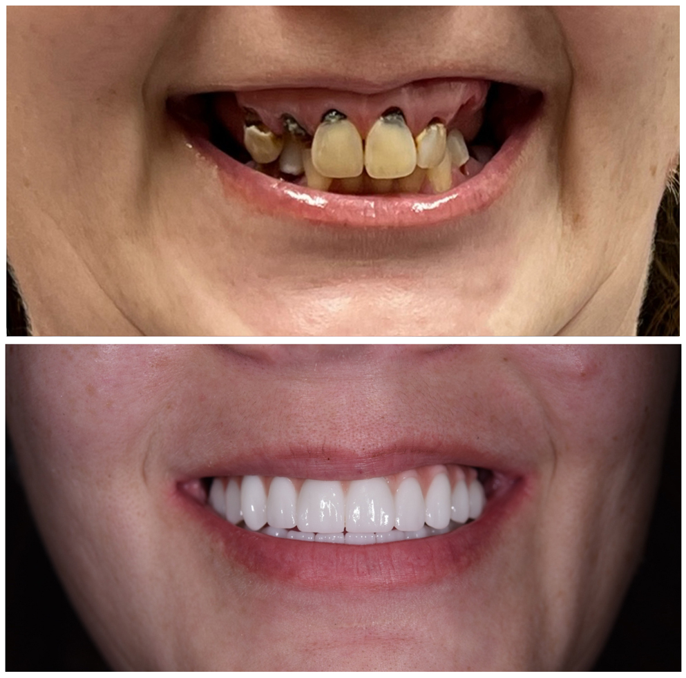 Teeth in a Day by Dr. Aydin