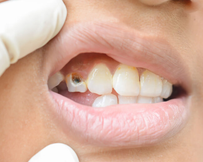 how long can you leave a cavity untreated