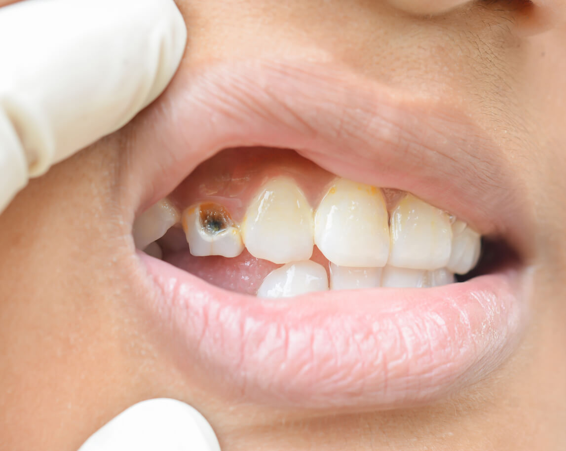 cavities how long can you leave a cavity untreated