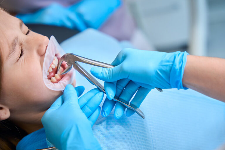 Tooth Extraction