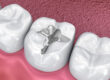 Composite Fillings