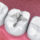 Composite Fillings