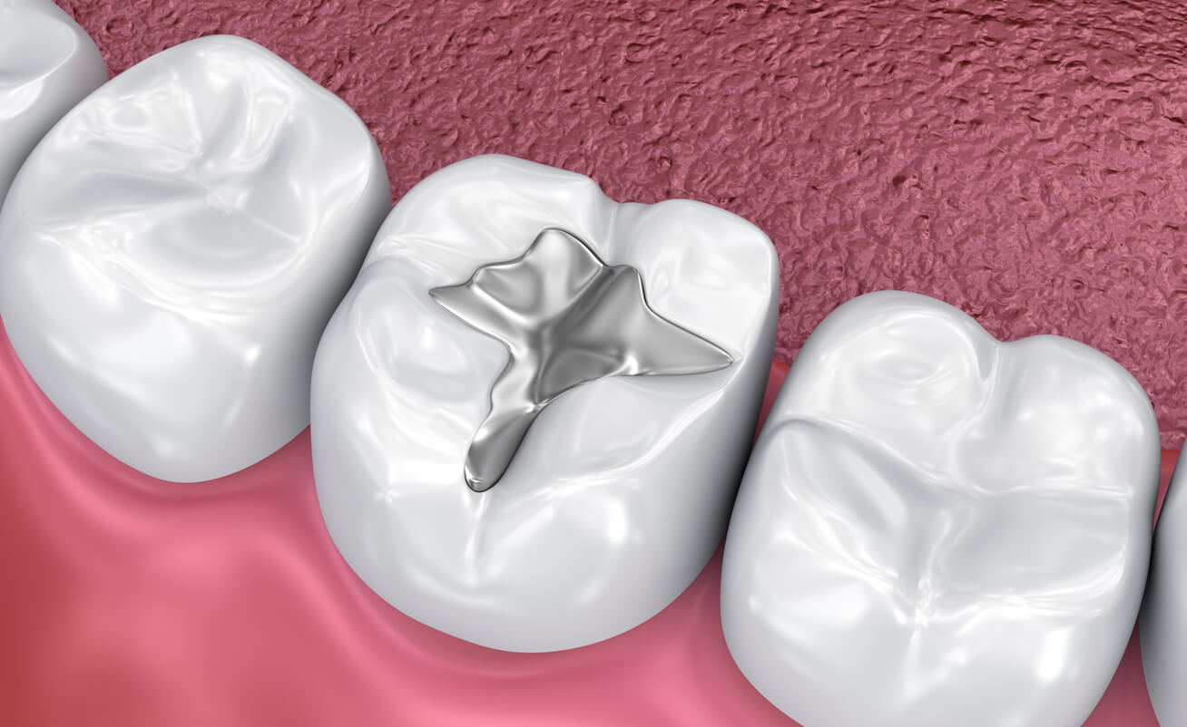 Composite Fillings Composite Fillings