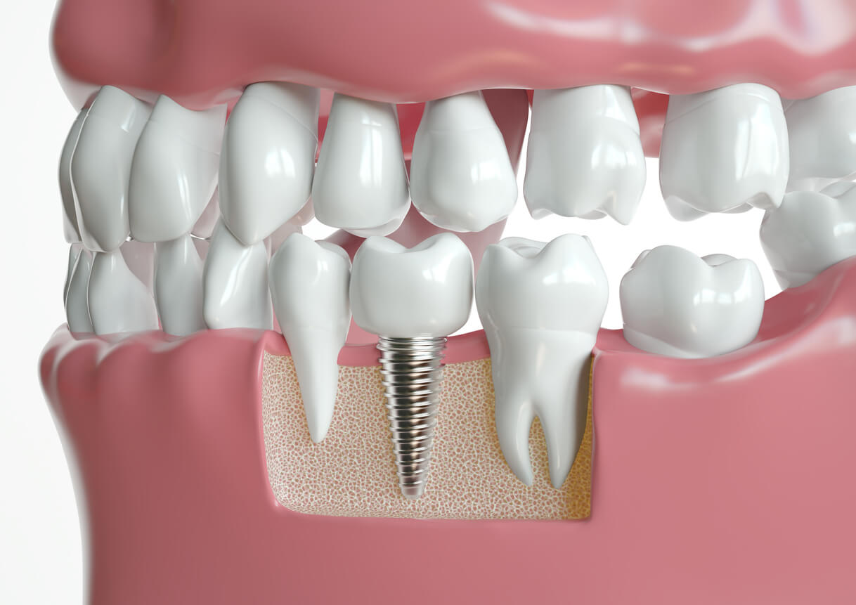 Dental Implants Benefits
