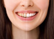 Teeth Whitening