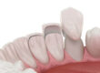 pros and cons of veneers