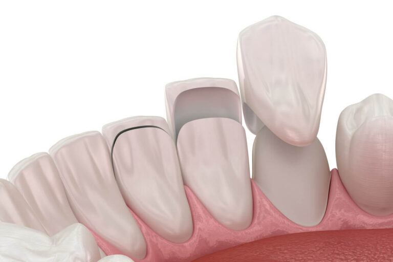 pros and cons of veneers