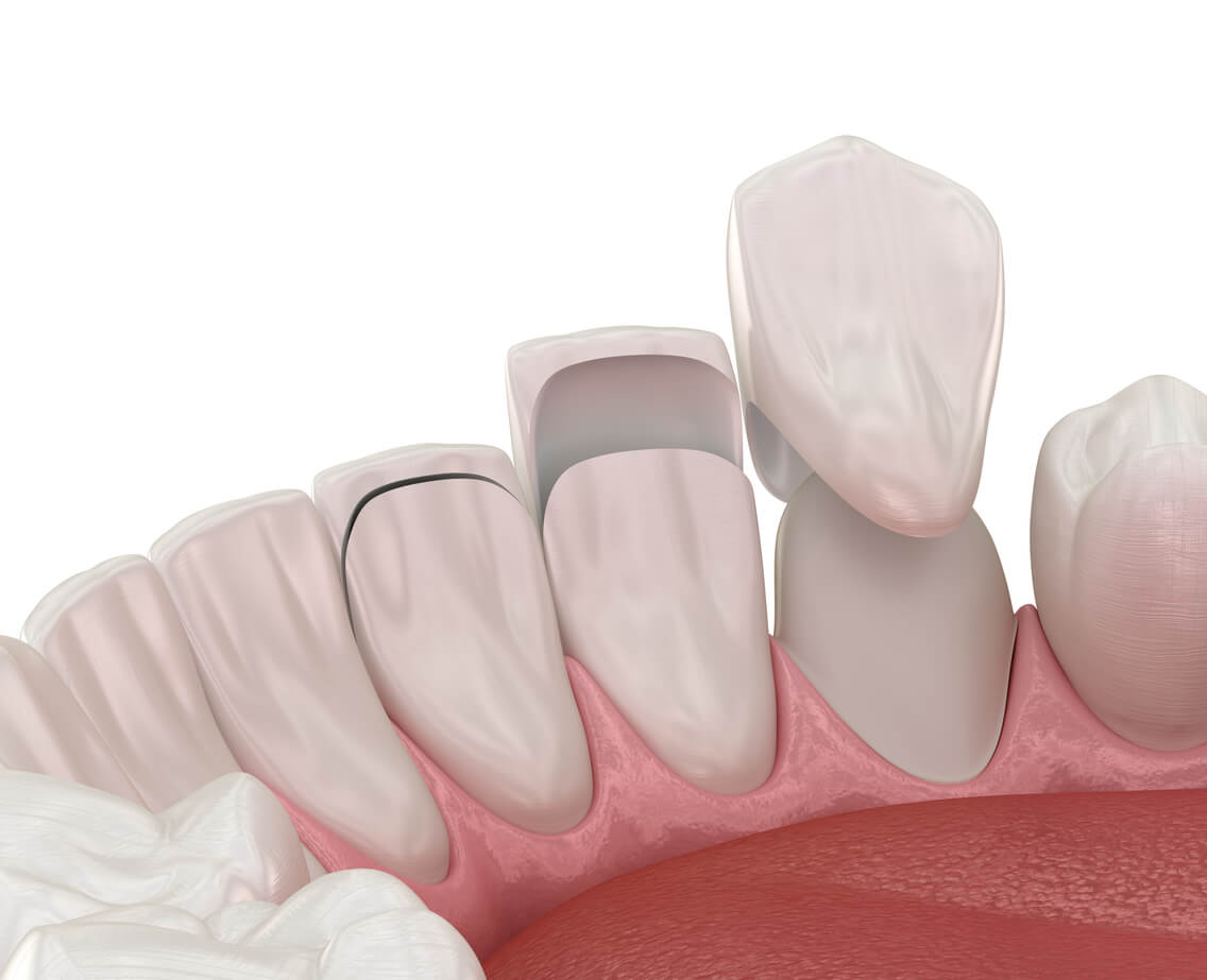 pros and cons of veneers pros and cons of veneers
