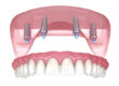 what is all on 4 dental implants