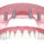 what is all on 4 dental implants