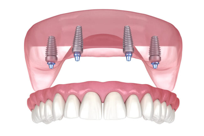 what is all on 4 dental implants what is all on 4 dental implants